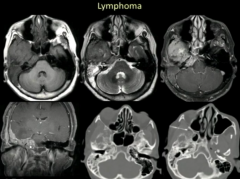 Lymphoma
 
Mimics Meningioma
