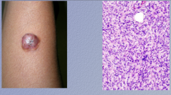 Raised, bulging, umbilicated
 
Less order in histiocyte cells, more cellularity and atypia than dermatofibroma. 
 
Diagnosis?