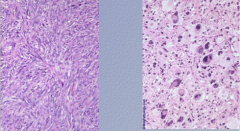 What cell types do you see? What is the pattern? What is the diagnosis?