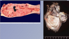 Fleshy-pink tumor, fish flesh appearance
 
What is the diagnosis?