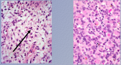 What type of cells shown? What type of cells recapitulate skeletal muscle cells? Diagnosis?