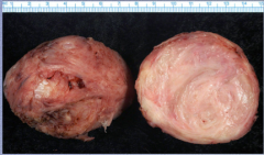 What is the tumor? Describe.
