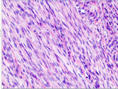 What do the cells look like? Are there mitoses and nuclear atypia? Large zones of what? Diagnosis?