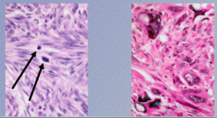 Leionmyosarcoma:
 
Which is low grade, high grade? 
 
How do you recognize low grade as malignant? High grade?