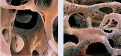 1.) Loss of bone mass via demineralization.

2.) Bones become weaker and more fragile.

3.) Results from increased osteoclast activity.

4.) Potential treatment is to inhibit activity of osteoclasts