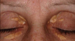 This is plaque like growth on the eyes caused by hyperlipideamia.