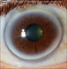 This is a light coloring (halo) around cornea. Can be caused by hyperlipidemia.
