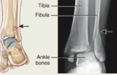 1.) Fracture of the distal end of the lateral fibula, with serious injury to the distal tibial articulation.