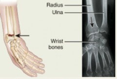 1.) Fracture of the distal end of the radius in which the distal fragment is displaced posteriorly.
