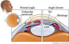 acute angle closure crises characterized by 
- sudden ocular pain
-  seeing halos around lights
-  red eye
- nausea and vomiting
- suddenly decreased vision
- very high intraocular pressure (>30 mmHg)
- fixed, mid-dilated pupil. 

It is a...