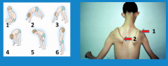 Left right
 
What is the most common symptom of neuromuscular disease?