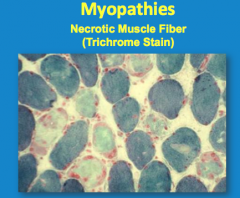 Are the muscle fibers atrophic and angular in myopathies? How do they appear here? 
 
Is the number of motor units decreased in myopathies? 
 
What do the dead fibers leak?