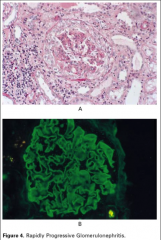 *AKA "Crescentic."
*Rapid onset of renal failure (days-weeks).
*LM shows >50% of glomeruli with crescents.

*3 types:
1) Pauci-immune (vasculitis).
2) Anti-GBM disease (e.g. Goodpasture’s; shown in bottom pic. You can tell this is anti-GBM...