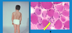 What three things do you see on the boy with muscular dystrophy?
 
What is the arrow pointing to?