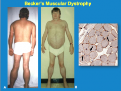 What are some differences between Becker and Duchenne muscular dystrophy?