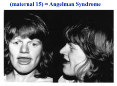 microdeletion on long arm of maternal chromosome 15, mental retardation, cannot speak, craniofacial defects, poor motor development