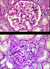 Discuss Focal Segmental Glomerulosclerosis:
How does it progress?
How common? Who gets it?
What are the subtypes?
