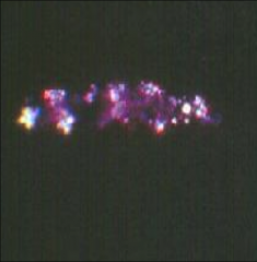 FATTY CASTS IN THE URINARY SEDIMENT, under polarized light.
