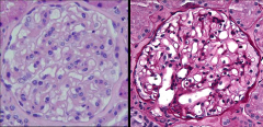 *NORMAL GLOMERULI*
L: H/E stain.
R: PAS stain (the standard). Shows glycogenated material, i.e. the GBM. Bottom is vascular pole. Capillary lumina are patent. GBM is flimsy looking. Mesangial matrix is sparse (only 1 or 2 cells present in periph...