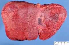 1. liver disease (most common initial manifestation)- varies but may include acute hepatitis, cirrhosis, and/or fulminant liver failure
2. Kayser-Fleisher rings- yellowish rings in the cornea caused by copper deposition-- does not interfere with ...