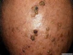 WHAT IS ACTINIC KERATOSIS