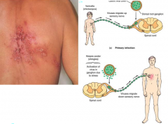 Shingles: when chickenpox(or other Caricella-zoster viruses) is reactivated in a grownup.
