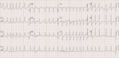 


DC cardioversion 

DX Peri-arrest rhythms: tachycardia