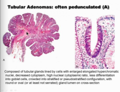 Enlarged, elongated, hyperchromatic nuclei


 


Normal on right side of right image, abnormal of left side of right image (bigger nuclei, elongated, crowded, pseudo stratified, NOT AS MANY goblet cells).