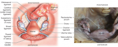 Suspensory Ligaments of the Uterus 
