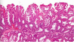 What type of adenoma? Location? Which part of colon (right or left)? 