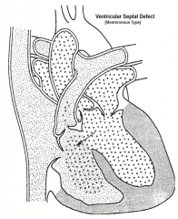 Ventricular Septal Defect (VSD) = 25% of all Congenital Heart Defects