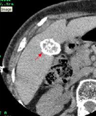 - Plain abdominal x-ray
- CT
- Abdominal ultrasound