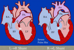 - L-->R shunt (oxygenated blood flows from LV to RV) because of high systemic pressure relative to pulmonic pressure
- This can cause severe pulmonary hypertension
- This may convert the shunt to R-->L causing cyanosis