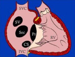 - Secundum type (most common, 90%) = at fossa ovale
- Primum type = at original ostium primum, adjacent to AV valves (5%)
- Sinus Venosus type = near SVC entrance (5%)