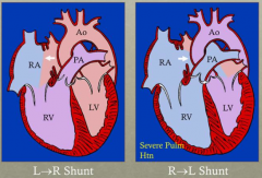 - Initial: L-->R shunt
- If progresses to severe pulmonary hypertension: R-->L shunt