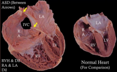 - Right Ventricular Hypertrophy and dilation
- Right Atrial and Left Atrial dilation