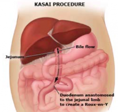 - Kasai procedure: perform ASAP, jejunum attached to liver to drain bile and duodenum is attached lower down on jejunum 
- Liver transplantation