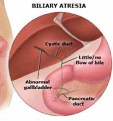 - Biliary obstruction exclusively in the neonatal period
- Progressive, idiopathic, fibro-obliterative disease of the extra-hepatic biliary tree

*Complete obstruction of bile flow caused by destruction or absence of all or part of the extra-he...