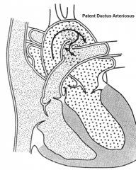 Pulmonary trunk and Aorta