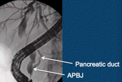 - Pancreatic and bile ducts join together outside the duodenal wall
- Associated with biliary cysts
- Associated with increased risk of gallbladder cancer independent of biliary cysts