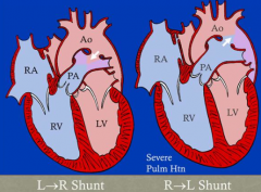 - Normal: L-->R shunt
- Can switch to R-->L shunt if there is severe pulmonary hypertension