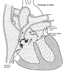 Severity of pulmonary trunk stenosis determines degree of cyanosis