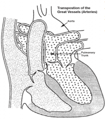- Aorta arises from RV
- Pulmonary artery arises from LV