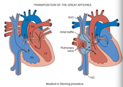 - Tx for transposition of great vessels
- Atrial switch