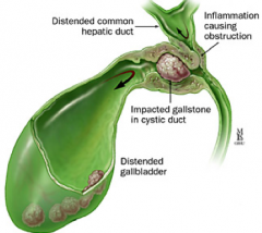 - Common hepatic duct obstruction from extrinsic compression
- May be by an impacted stone in the cystic duct or Hartmann's pouch of the gallbladder