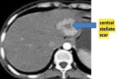 No - FNH is found in non-cirrhotic livers