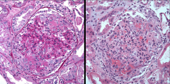 *L: PAS stain, showing extracapillary hypercellularity (cellular crescents).
*R: Same glomerulus on H/E, showing fibrinoid necrosis.