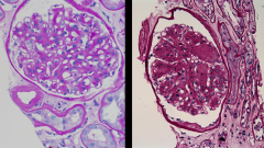*L: Diffuse mesangial sclerosis in early diabetic nephropathy.
*R: Nodular mesangial sclerosis in late diabetic nephropathy (Kimmelstein-Wilson nodules).