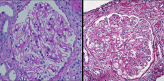 *L: Membranous nephropathy, showing Thickened 
GBMs.
*R: Duplicated GBMs (“double contours”).