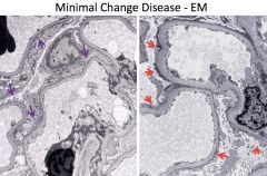 L: Normal
R: Minimal change showing podocyte effacement.